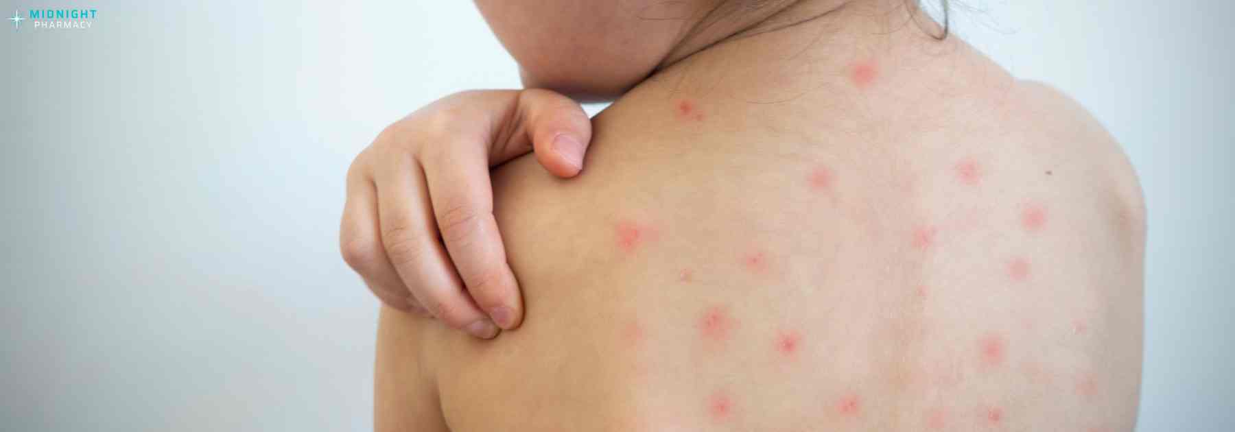 chickenpox vaccine bradford