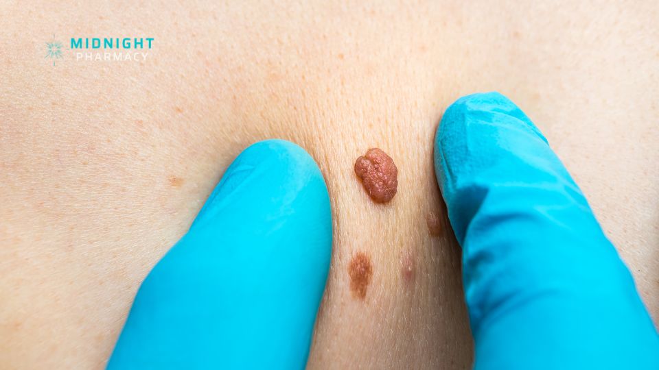 Skin tag up close being held by fingers in blue gloves