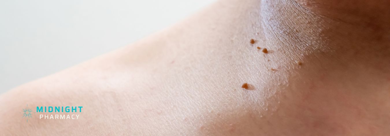 Skin tags on a woman's neck