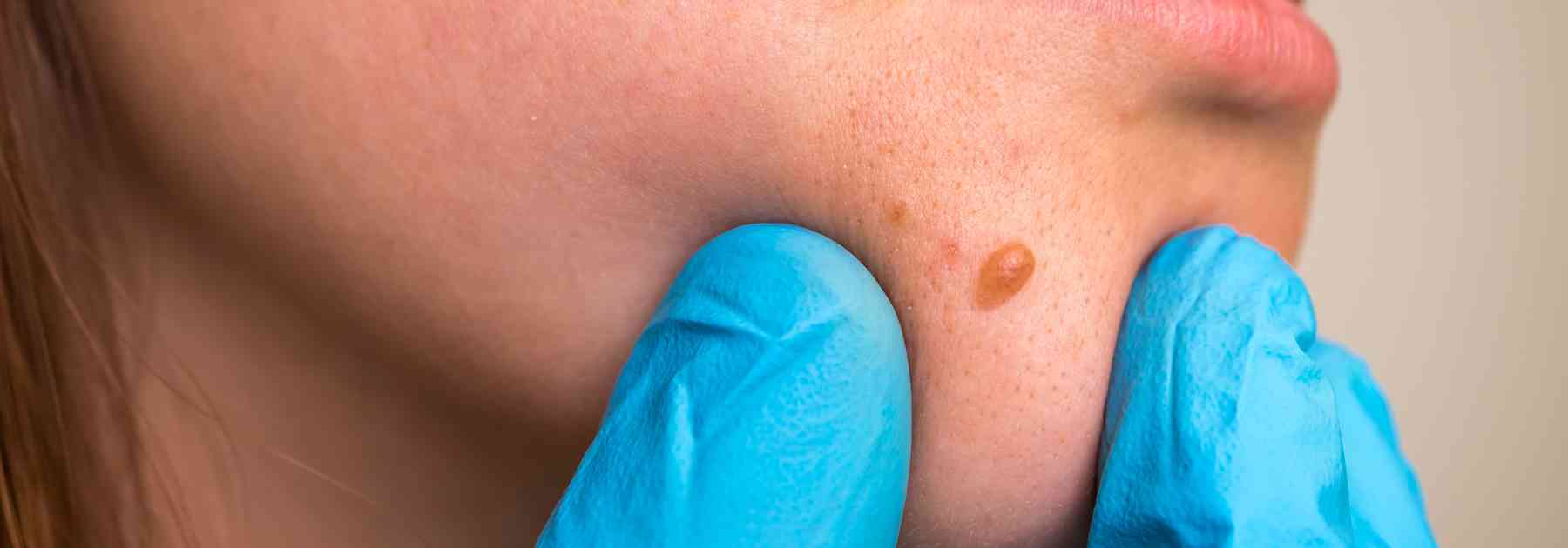 How to remove skin tags at home safely. 