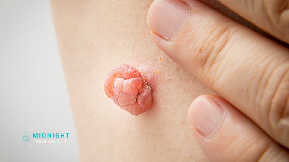 Close up picture of a skin tag