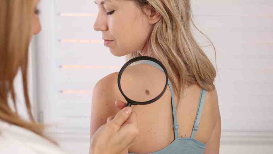 How to remove skin tags at home