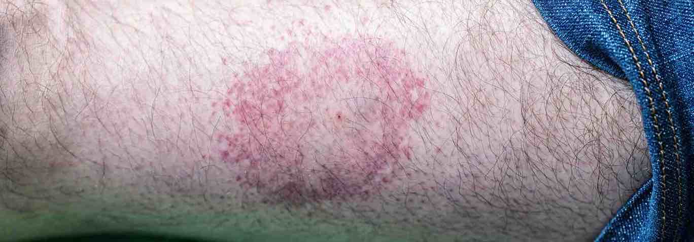 How vaccines and a tick remover tool can protect your travels