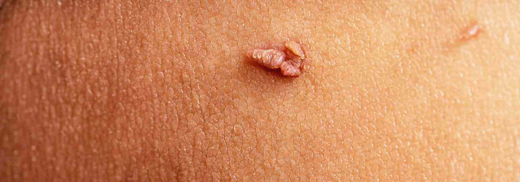 Close up image of a skin tag for removal 