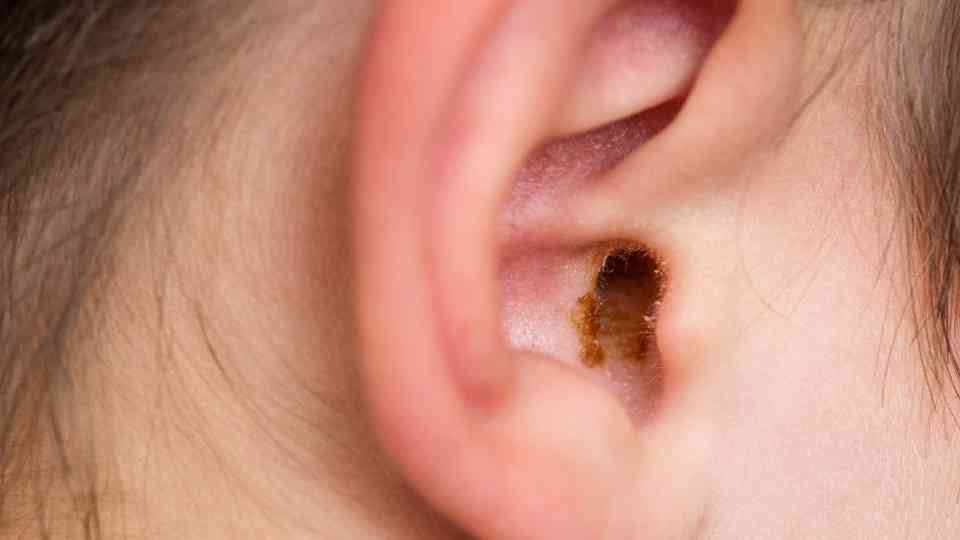 Earwax build up