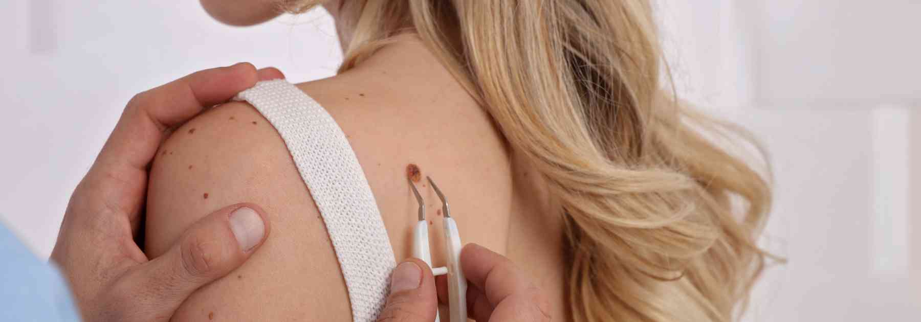 Skin tag check at a Bradford pharmacy. 