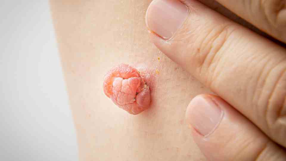 Skin tag that needs to be removed