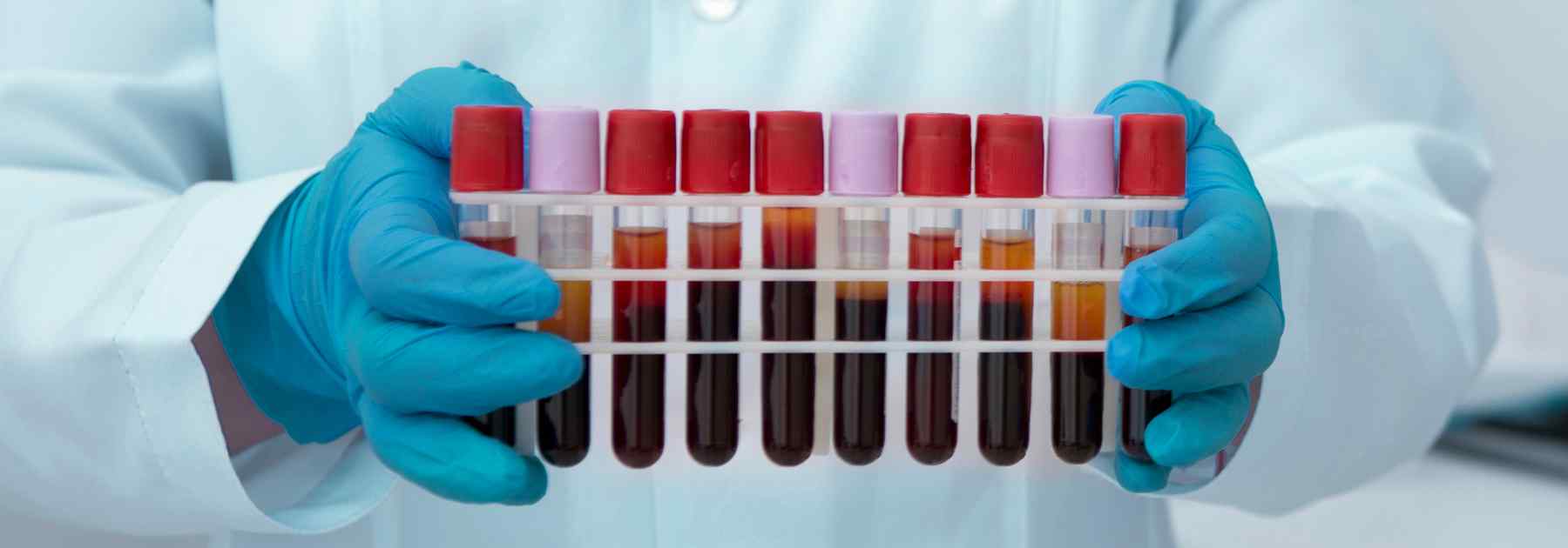 Tray of blood test tubes