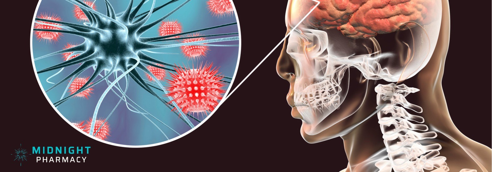 Diagram represeting brain infection from meningitis